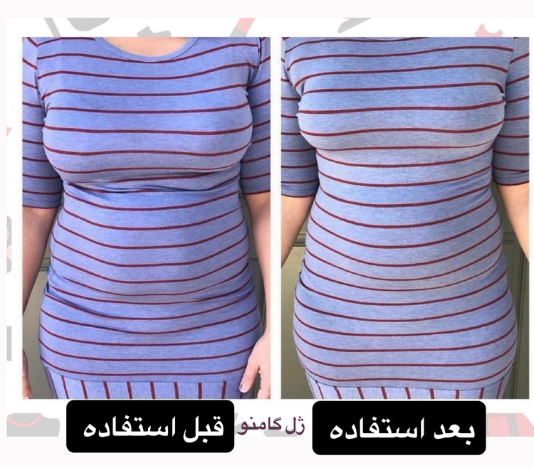 کوچک کننده سینه