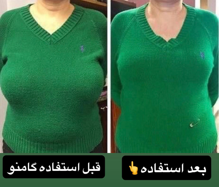 کوچک کننده سینه
