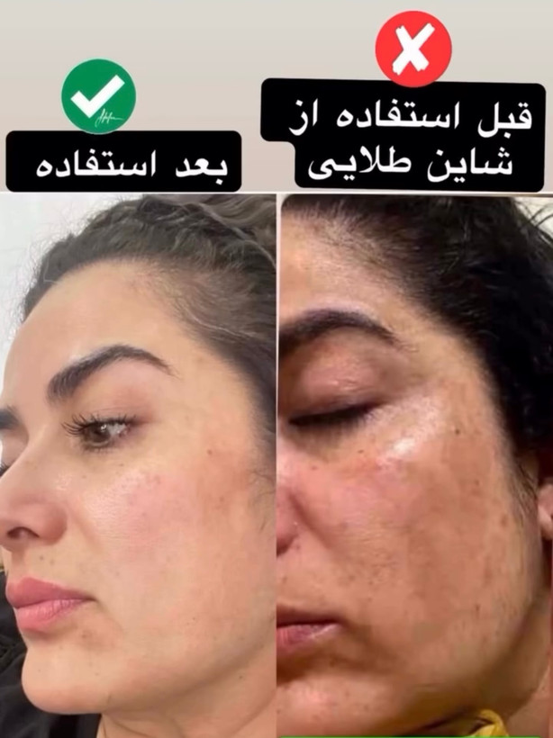 پک گیاهی ضد لک و جوش شاین طلایی