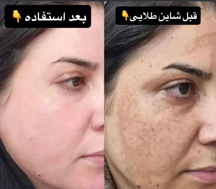 پک گیاهی ضد لک و جوش شاین طلایی