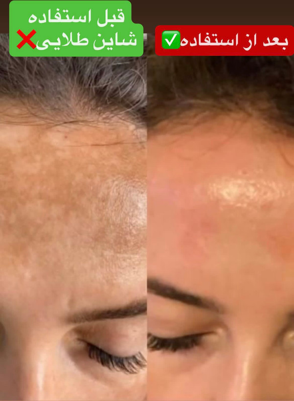 پک گیاهی ضد لک و جوش شاین طلایی