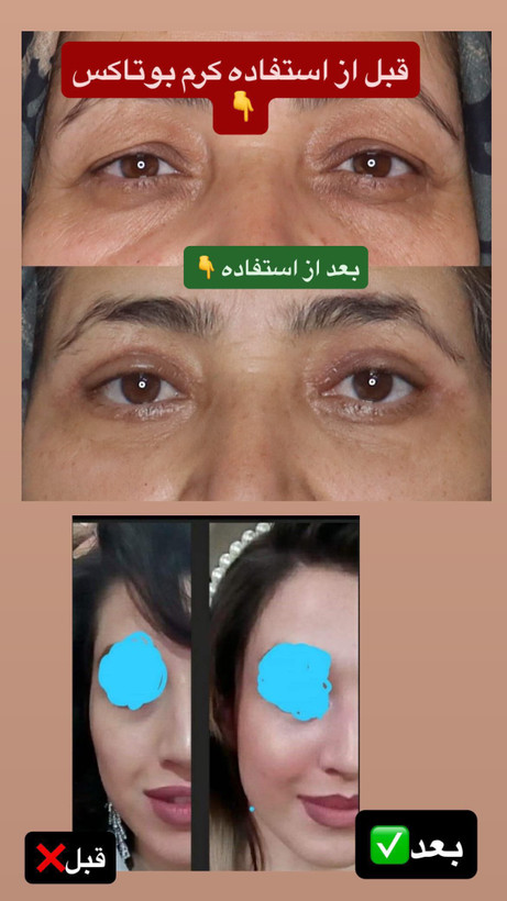 کرم بوتاکس