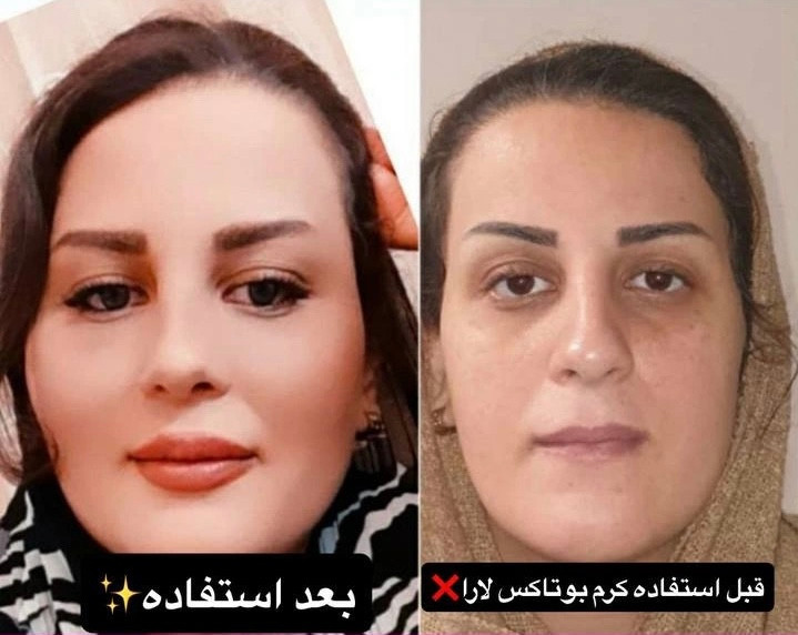 کرم بوتاکس