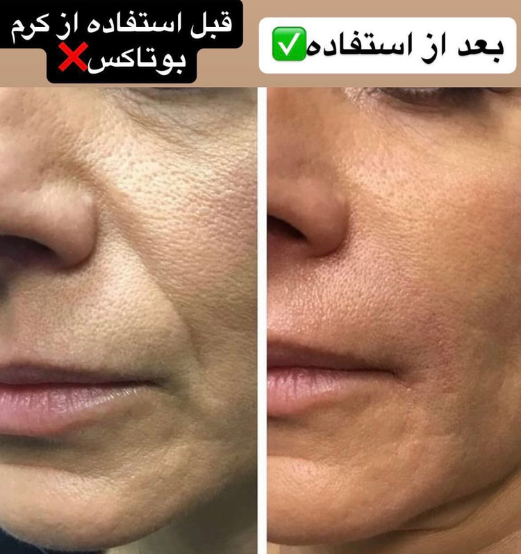 کرم بوتاکس