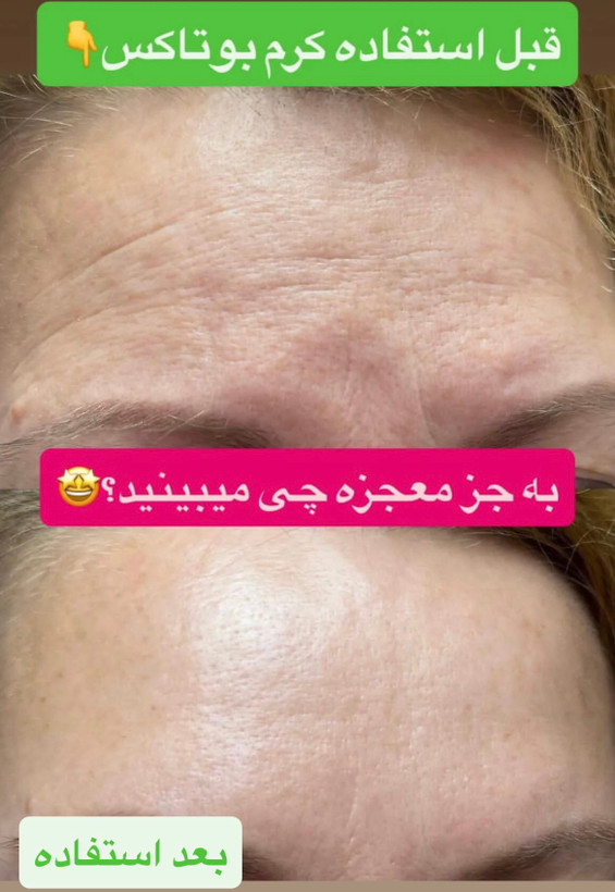 کرم بوتاکس