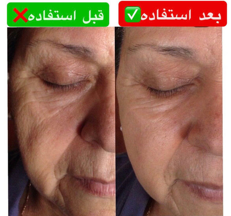 کرم بوتاکس